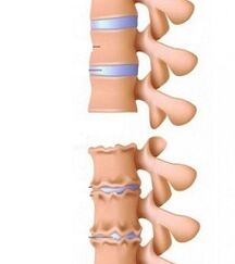 Στάδια των ράμπων της οστεοχονδρίωσης του λαιμού