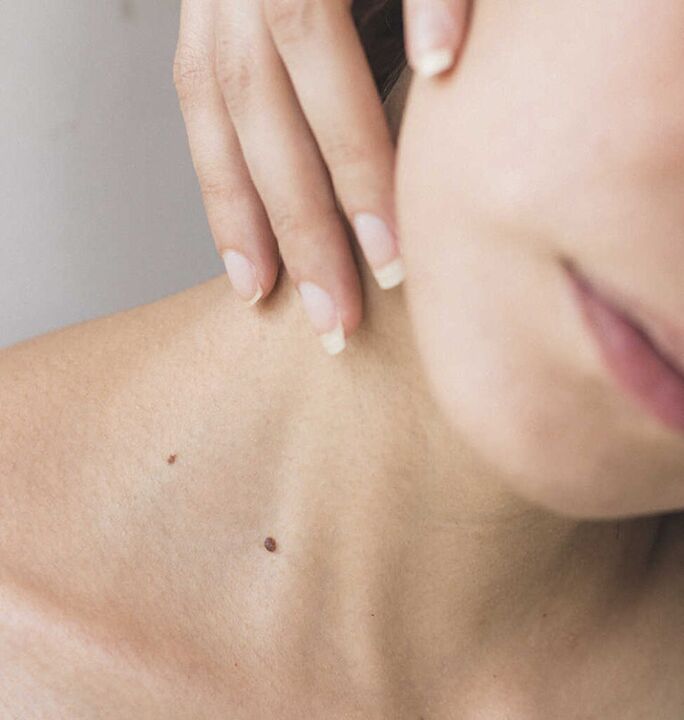 Η δυσκαμψία στον αυχένα είναι ένα από τα συμπτώματα στα αρχικά στάδια της οστεοχόνδρωσης της αυχενικής μοίρας της σπονδυλικής στήλης