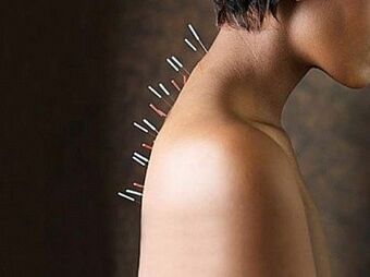 Η ρεφλεξοθεραπεία είναι μια αποτελεσματική μέθοδος θεραπείας της οστεοχονδρωσίας του τραχήλου της μήτρας